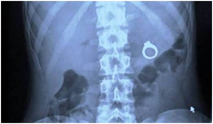 5 Benda Ini Bisa Masuk ke Tubuh Manusia, Ada Granat Aktif hingga Cincin Tunangan? 5 Benda Ini Bisa Masuk ke Tubuh Manusia, Ada Granat Aktif hingga Cincin Tunangan?